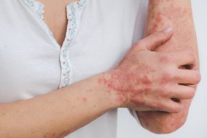 skin diseases caused by polluted water